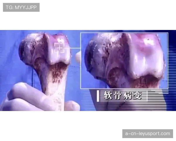半月板切除:把软骨拿掉,职业生涯也切掉一块,半月板切了有什么影响 半月板切除:把软骨拿掉,职业生涯也切掉一块,半月板切了有什么影响
